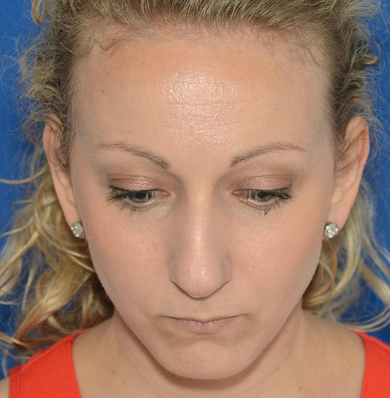 Rhinoplasty Before & After Gallery - Patient 115931 - Image 5