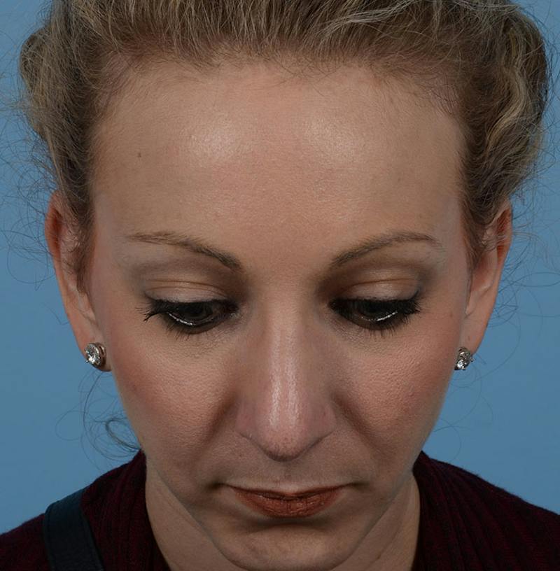 Rhinoplasty Before & After Gallery - Patient 115931 - Image 6