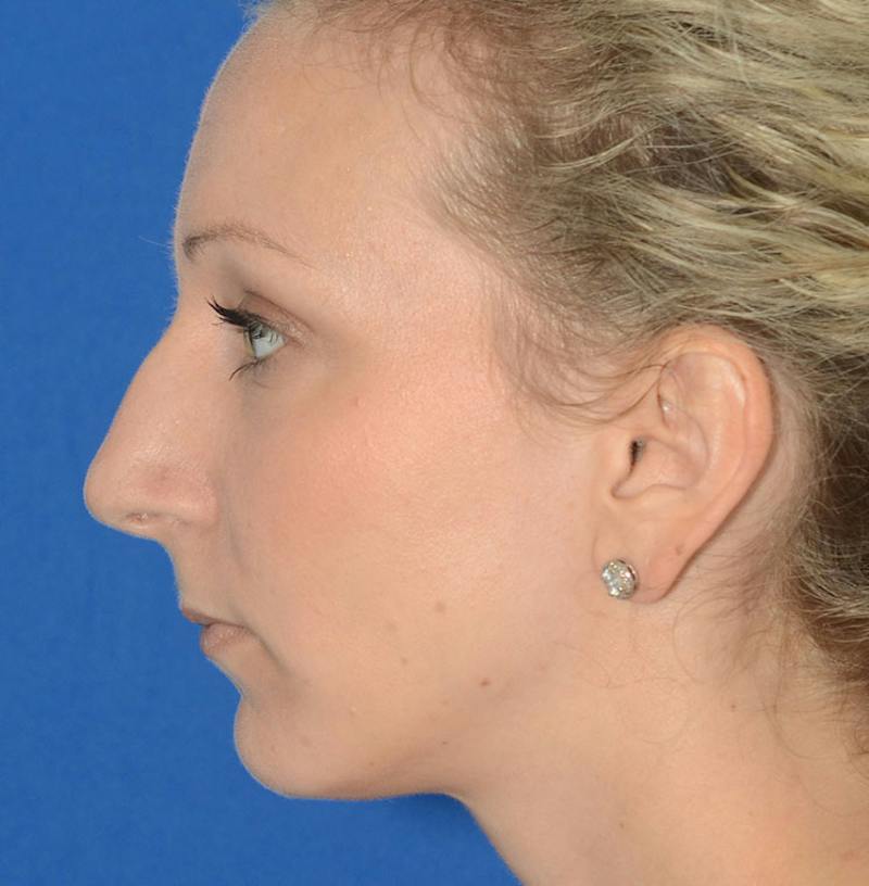 Rhinoplasty Before & After Gallery - Patient 115931 - Image 7
