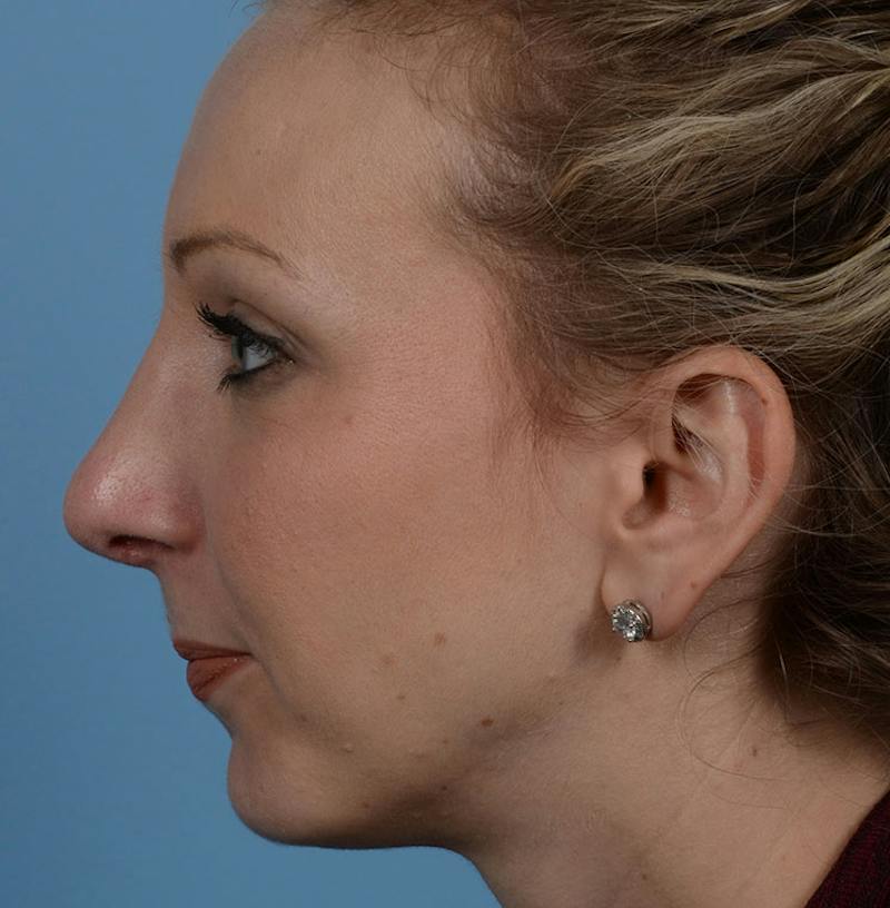 Rhinoplasty Before & After Gallery - Patient 115931 - Image 8