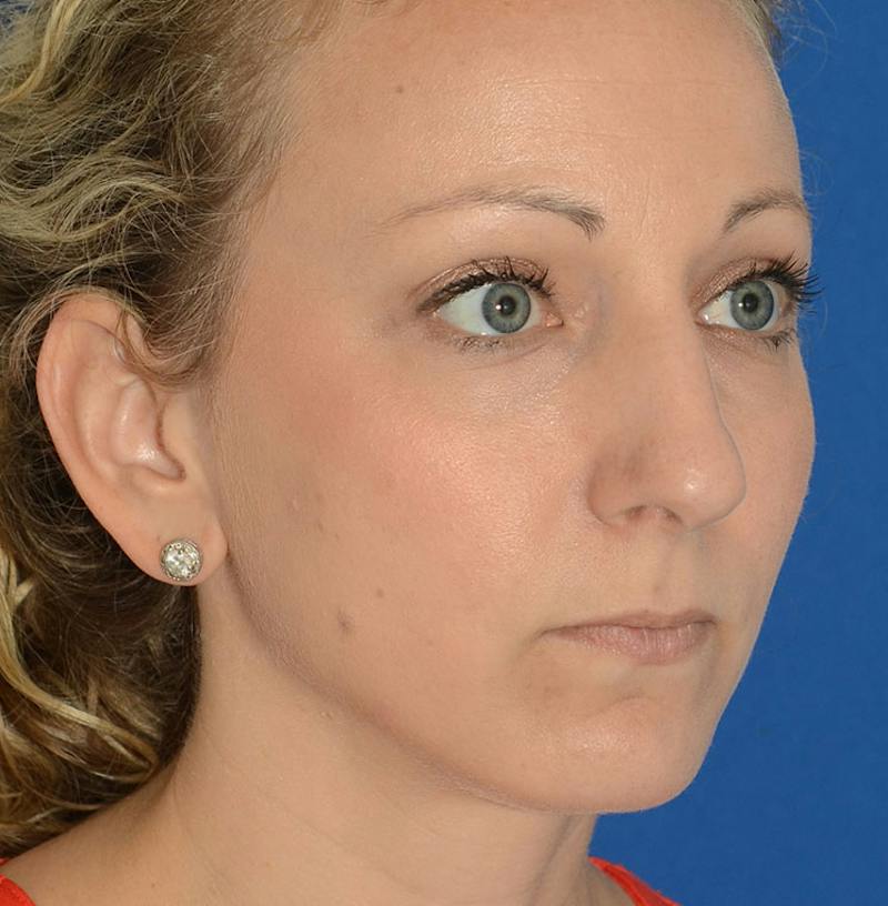 Rhinoplasty Before & After Gallery - Patient 115931 - Image 9