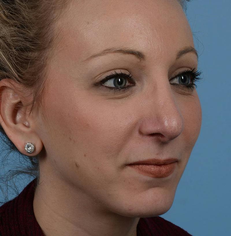 Rhinoplasty Before & After Gallery - Patient 115931 - Image 10