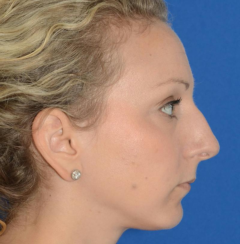 Rhinoplasty Before & After Gallery - Patient 115931 - Image 11