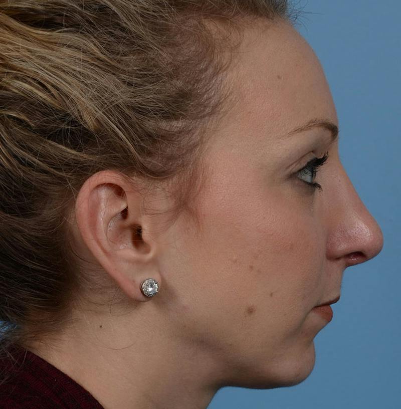 Rhinoplasty Before & After Gallery - Patient 115931 - Image 12
