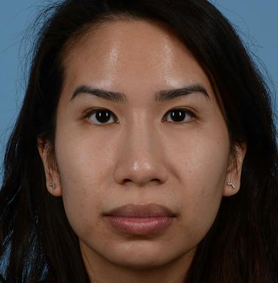 Rhinoplasty Before & After Gallery - Patient 280111 - Image 1