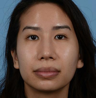 Rhinoplasty Before & After Gallery - Patient 280111 - Image 2