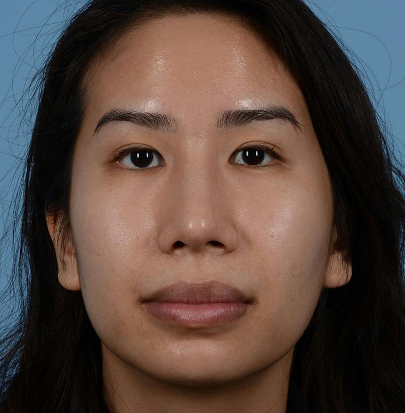 Rhinoplasty Before & After Gallery - Patient 280111 - Image 2