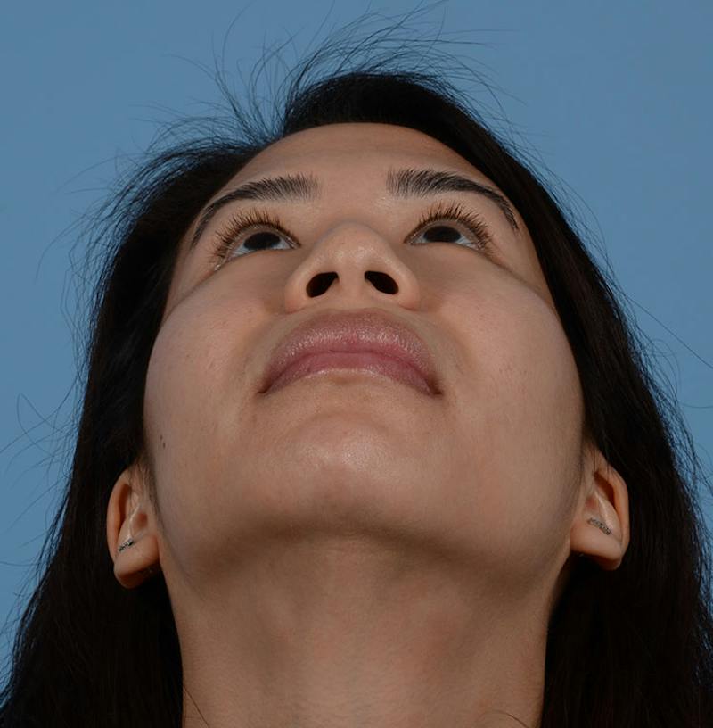 Rhinoplasty Before & After Gallery - Patient 280111 - Image 3