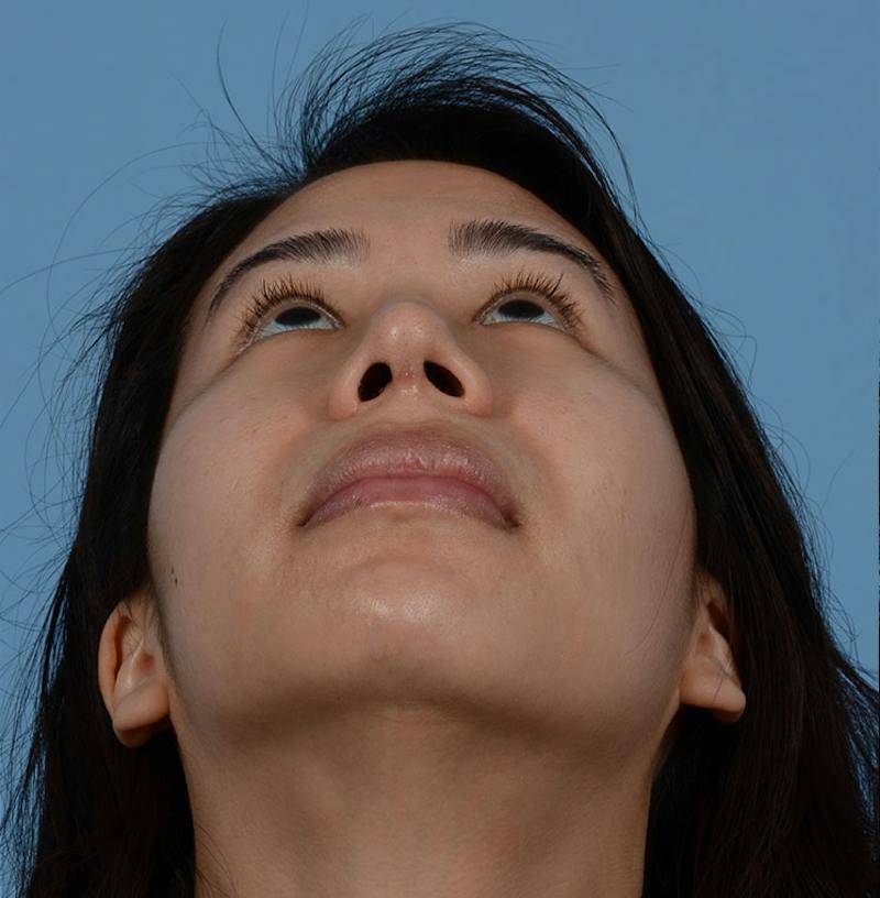 Rhinoplasty Before & After Gallery - Patient 280111 - Image 4