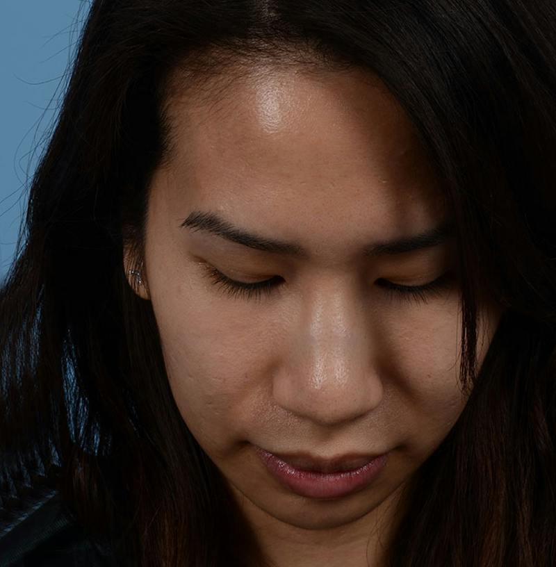 Rhinoplasty Before & After Gallery - Patient 280111 - Image 5