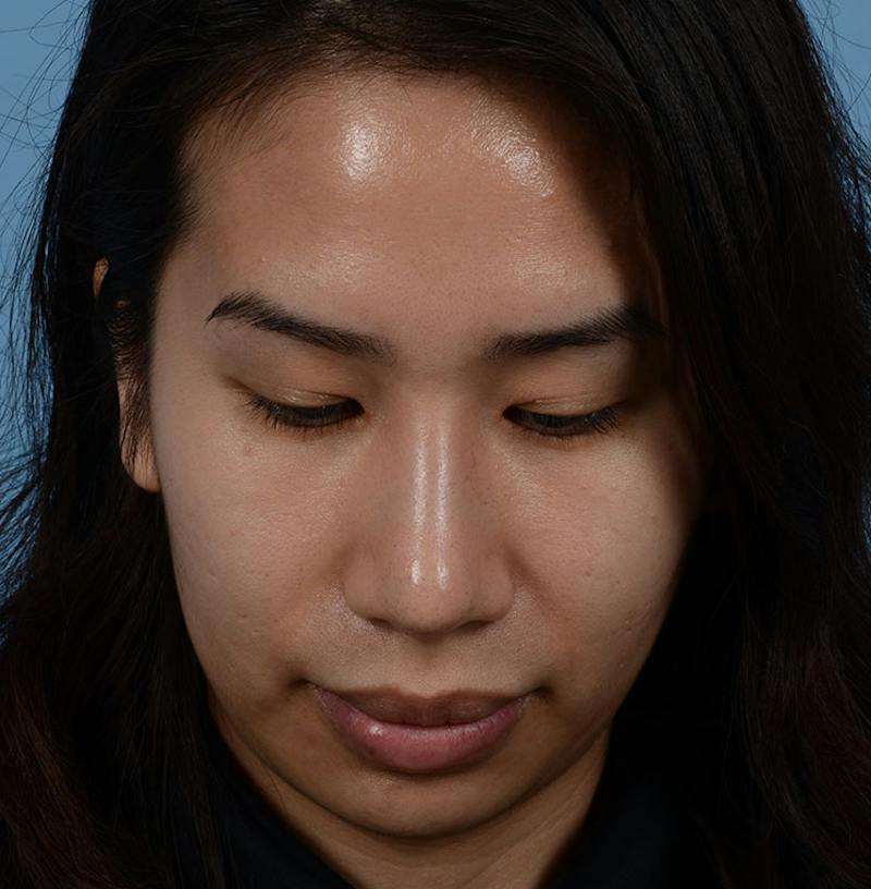 Rhinoplasty Before & After Gallery - Patient 280111 - Image 6