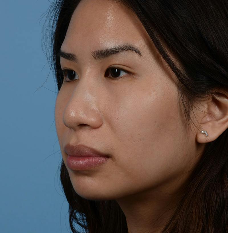 Rhinoplasty Before & After Gallery - Patient 280111 - Image 7