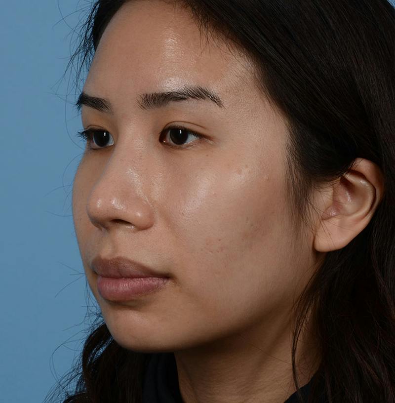 Rhinoplasty Before & After Gallery - Patient 280111 - Image 8
