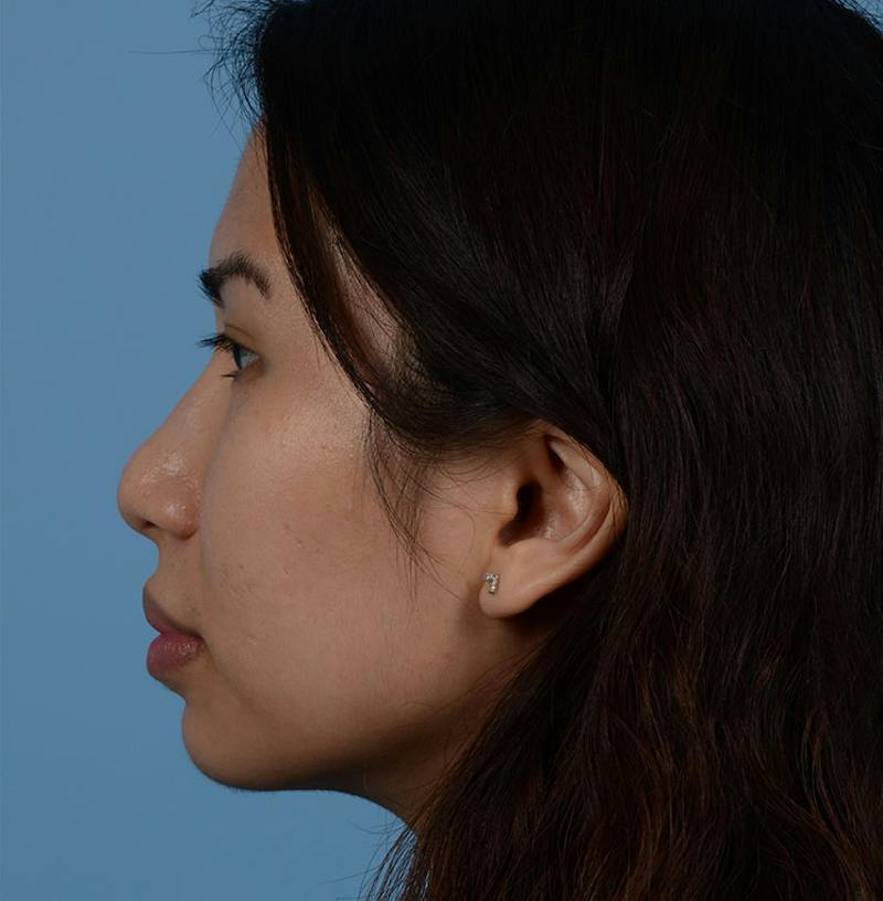 Rhinoplasty Before & After Gallery - Patient 280111 - Image 9
