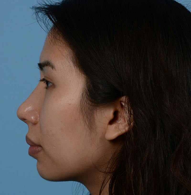 Rhinoplasty Before & After Gallery - Patient 280111 - Image 10