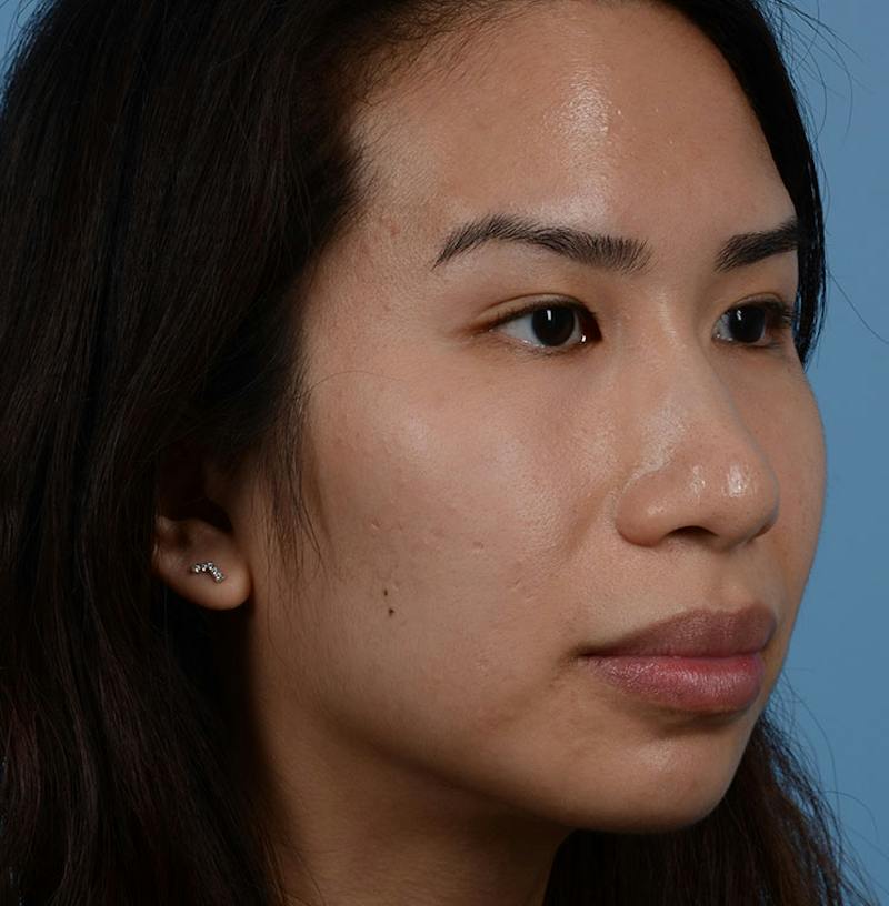 Rhinoplasty Before & After Gallery - Patient 280111 - Image 11