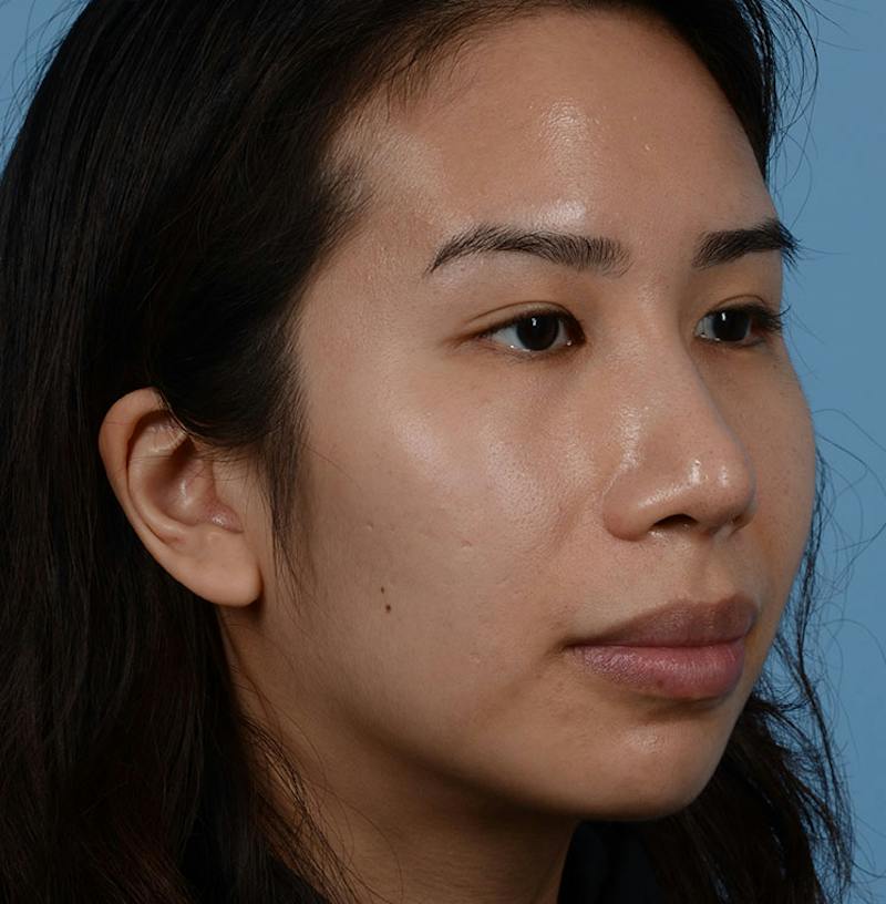 Rhinoplasty Before & After Gallery - Patient 280111 - Image 12