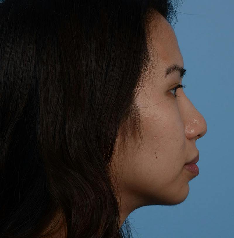 Rhinoplasty Before & After Gallery - Patient 280111 - Image 13