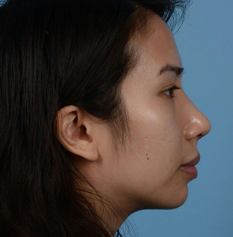 Rhinoplasty Before & After Gallery - Patient 280111 - Image 14