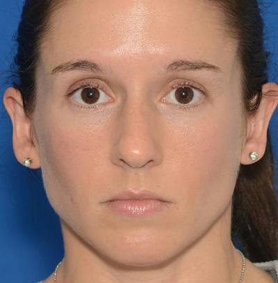 Rhinoplasty Before & After Gallery - Patient 607901 - Image 1