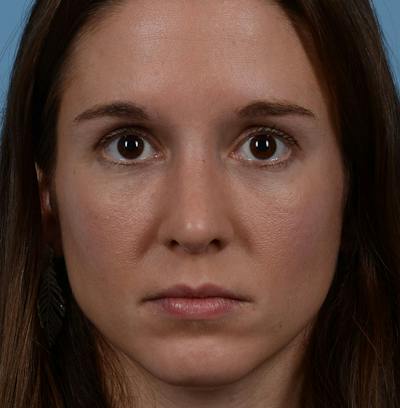 Rhinoplasty Before & After Gallery - Patient 607901 - Image 2