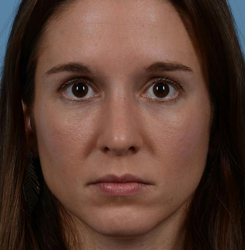Rhinoplasty Before & After Gallery - Patient 607901 - Image 2