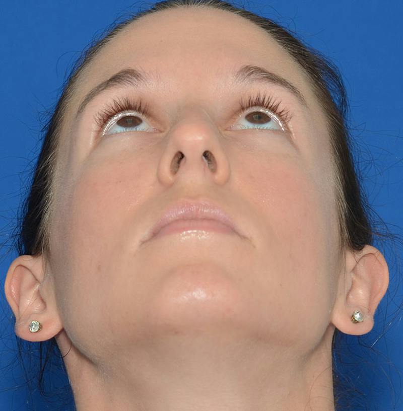 Rhinoplasty Before & After Gallery - Patient 607901 - Image 3