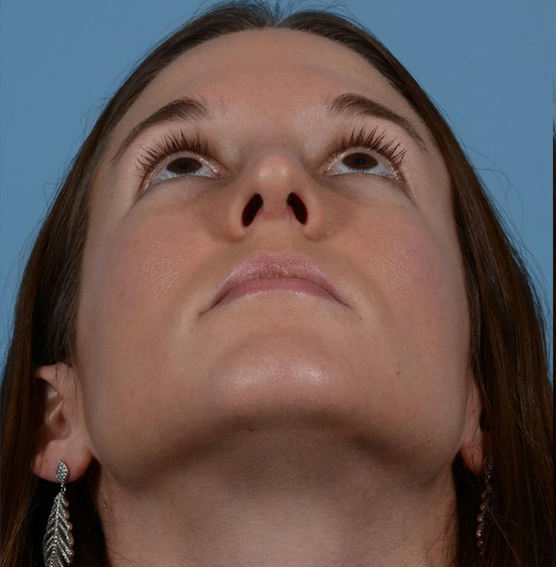 Rhinoplasty Before & After Gallery - Patient 607901 - Image 4