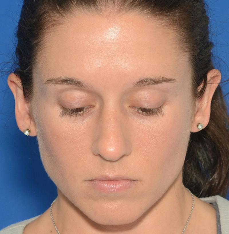 Rhinoplasty Before & After Gallery - Patient 607901 - Image 5