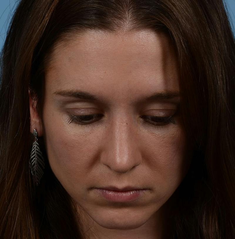 Rhinoplasty Before & After Gallery - Patient 607901 - Image 6
