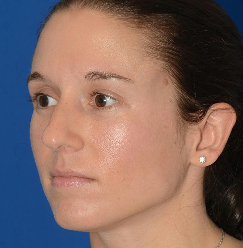 Rhinoplasty Before & After Gallery - Patient 607901 - Image 7