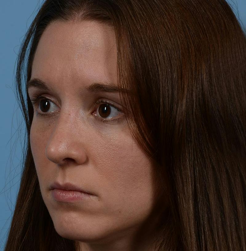 Rhinoplasty Before & After Gallery - Patient 607901 - Image 8