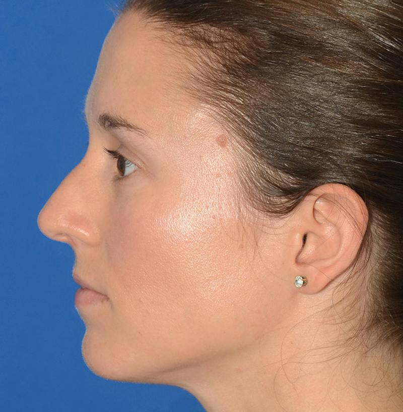 Rhinoplasty Before & After Gallery - Patient 607901 - Image 9