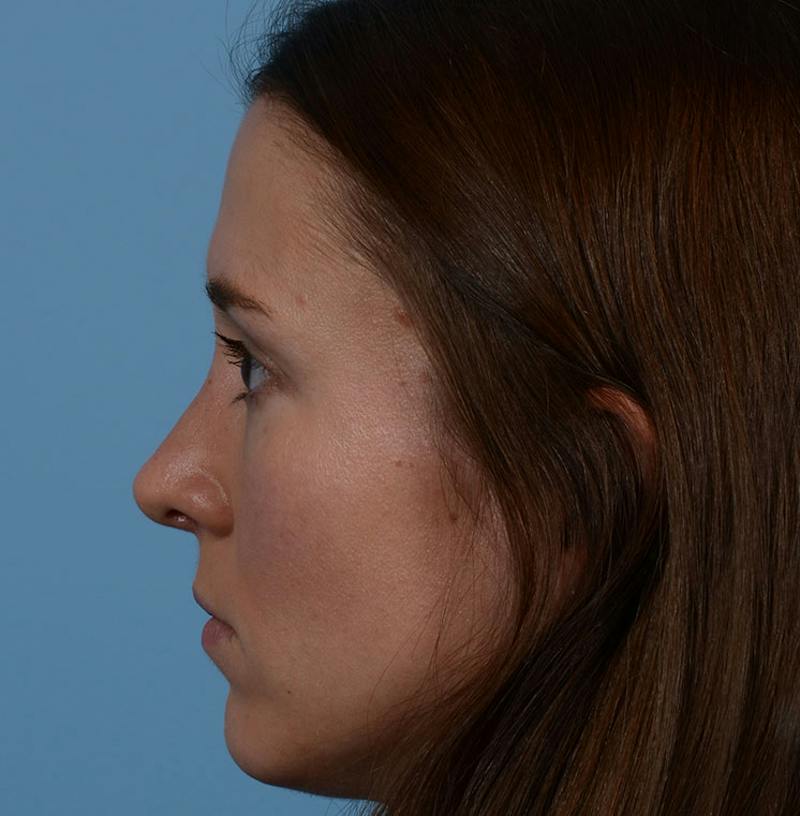 Rhinoplasty Before & After Gallery - Patient 607901 - Image 10