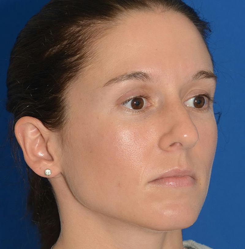 Rhinoplasty Before & After Gallery - Patient 607901 - Image 11