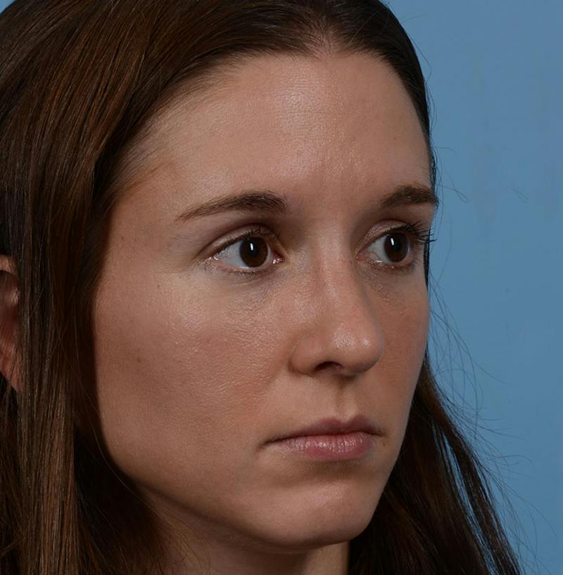 Rhinoplasty Before & After Gallery - Patient 607901 - Image 12