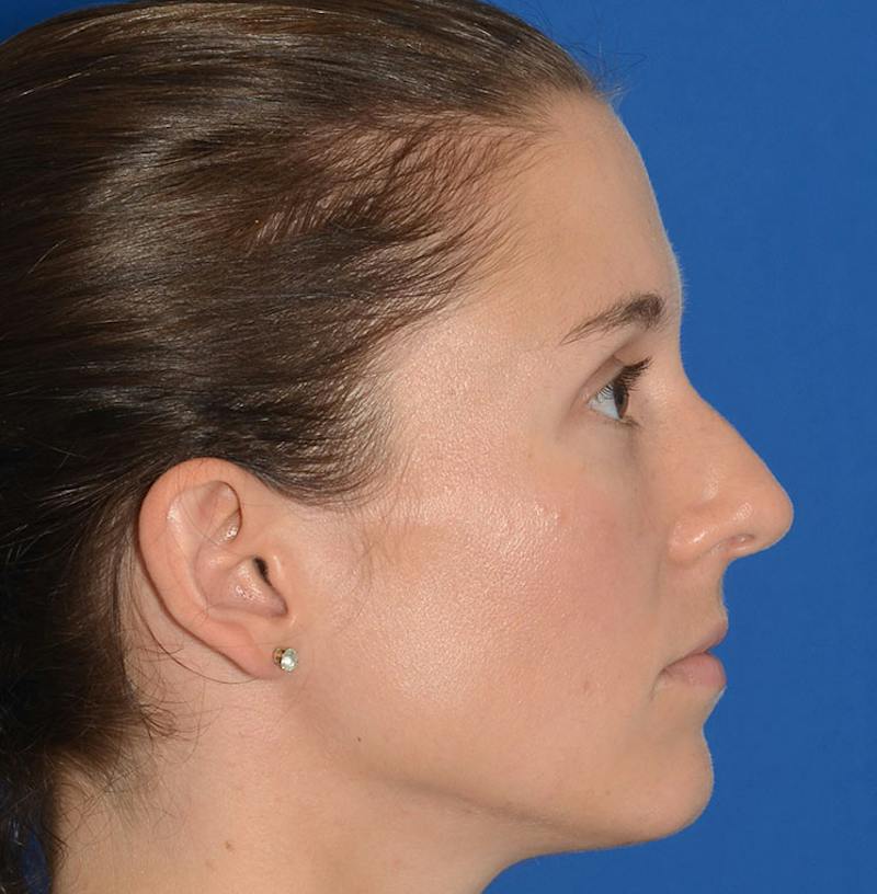 Rhinoplasty Before & After Gallery - Patient 607901 - Image 13
