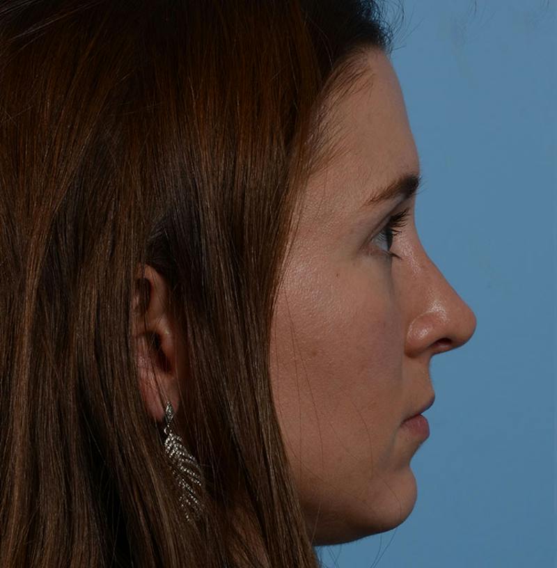 Rhinoplasty Before & After Gallery - Patient 607901 - Image 14
