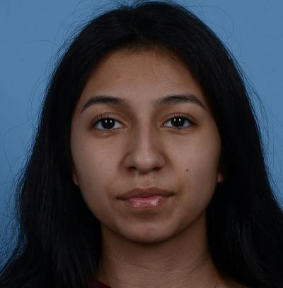Rhinoplasty Before & After Gallery - Patient 363516 - Image 1