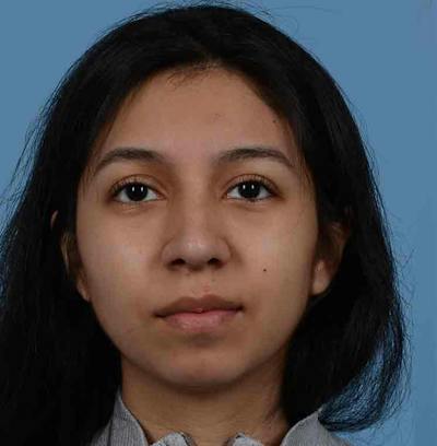 Rhinoplasty Before & After Gallery - Patient 363516 - Image 2