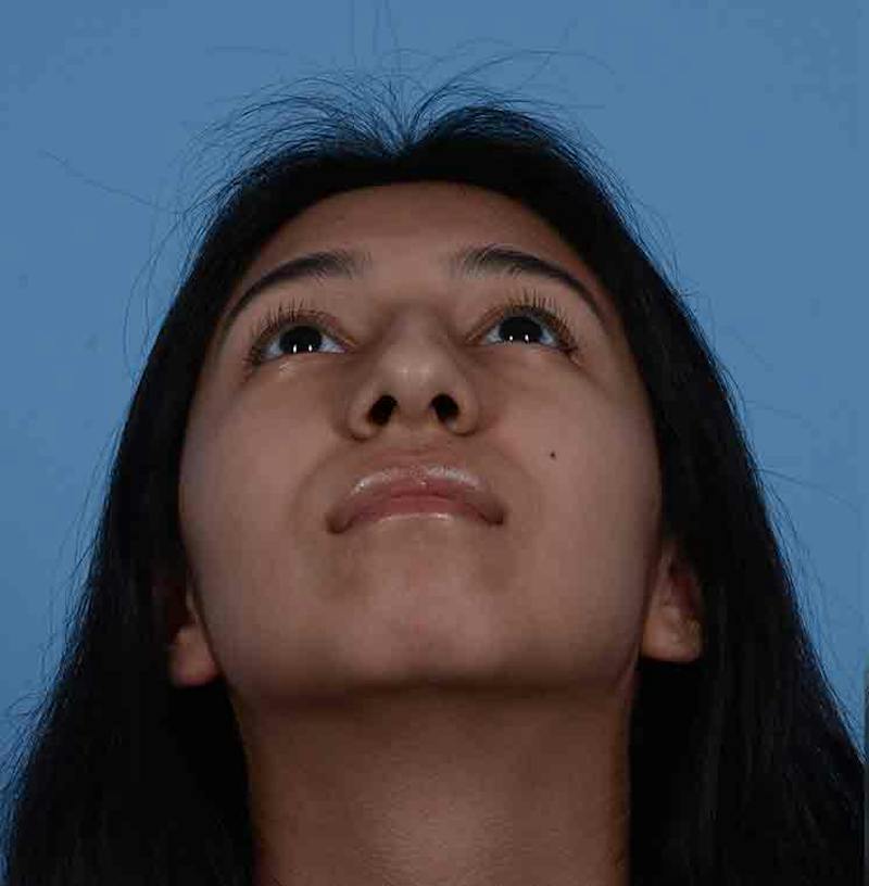 Rhinoplasty Before & After Gallery - Patient 363516 - Image 3