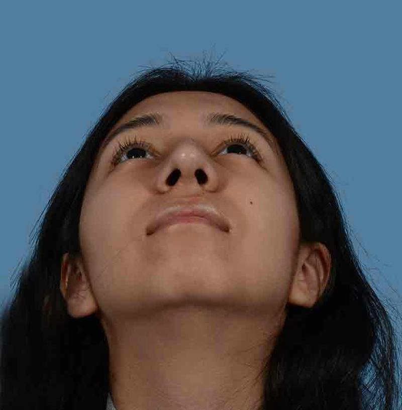 Rhinoplasty Before & After Gallery - Patient 363516 - Image 4