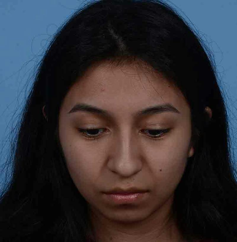 Rhinoplasty Before & After Gallery - Patient 363516 - Image 5