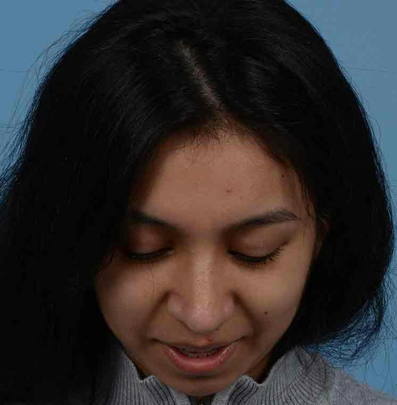 Rhinoplasty Before & After Gallery - Patient 363516 - Image 6