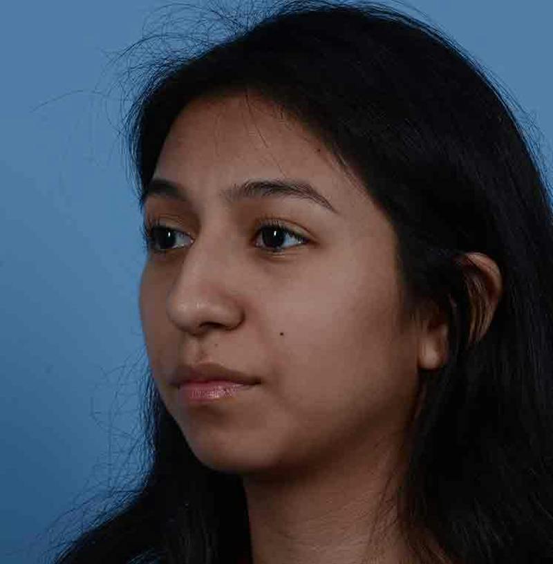 Rhinoplasty Before & After Gallery - Patient 363516 - Image 7