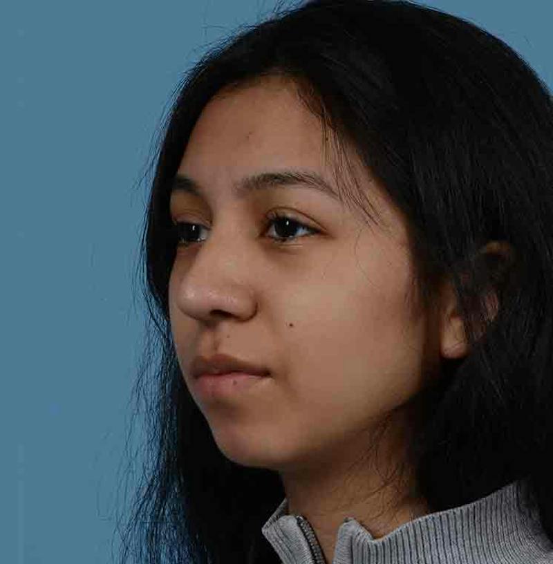 Rhinoplasty Before & After Gallery - Patient 363516 - Image 8