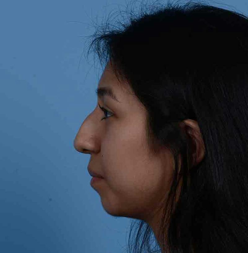 Rhinoplasty Before & After Gallery - Patient 363516 - Image 9