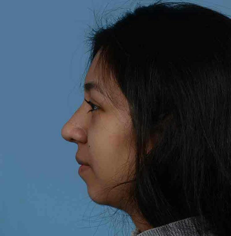 Rhinoplasty Before & After Gallery - Patient 363516 - Image 10