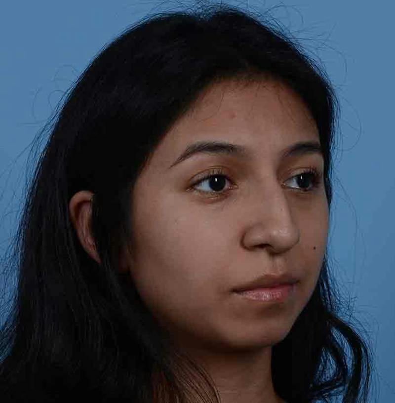Rhinoplasty Before & After Gallery - Patient 363516 - Image 11
