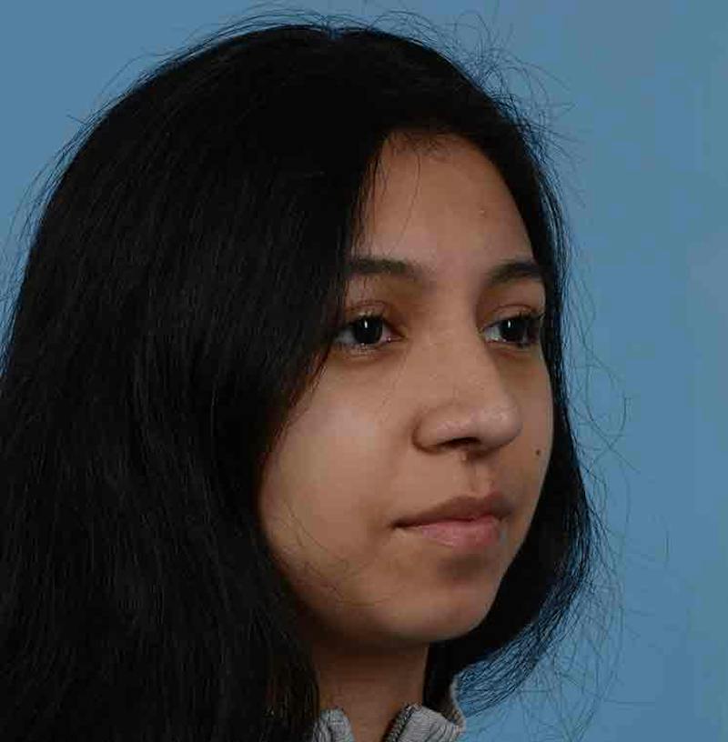Rhinoplasty Before & After Gallery - Patient 363516 - Image 12